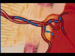 retinal vein occlusion