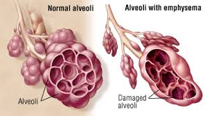 Emphysema