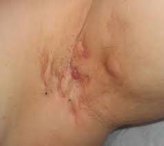 Hidradenitis Suppurativa