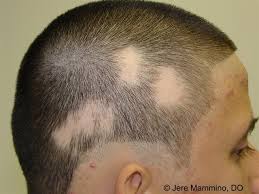 Alopecia