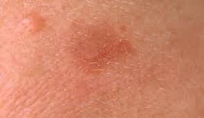 Actinic Keratosis