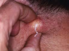 Herbal-Treatment-for-Sebaceous-Cyst