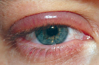 Protect Your Eyes From Blepharitis Common Eye Conditions - Herbs ...