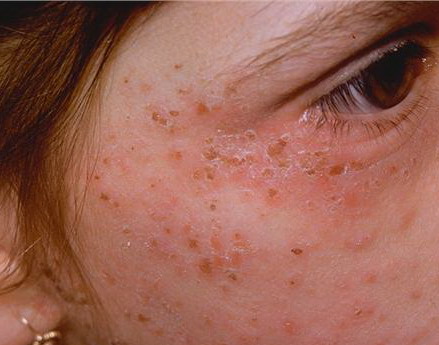 Facts About Porphyria Diverse Disease - Herbs Solutions By Nature