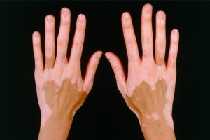 Vitiligo