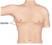 Things-You-Need-To-Know-About-Lipoma-Disease-Symptoms
