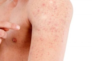 Keratosis-Pilaris