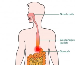 achalasia