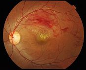 retinal-vein-occlusion