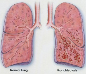 Bronchiectasis