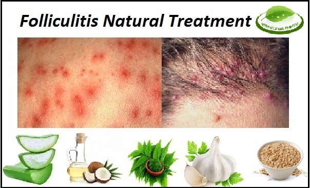 Folliculitis-Natural-Treatment