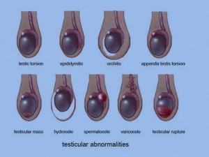 Epididymitis