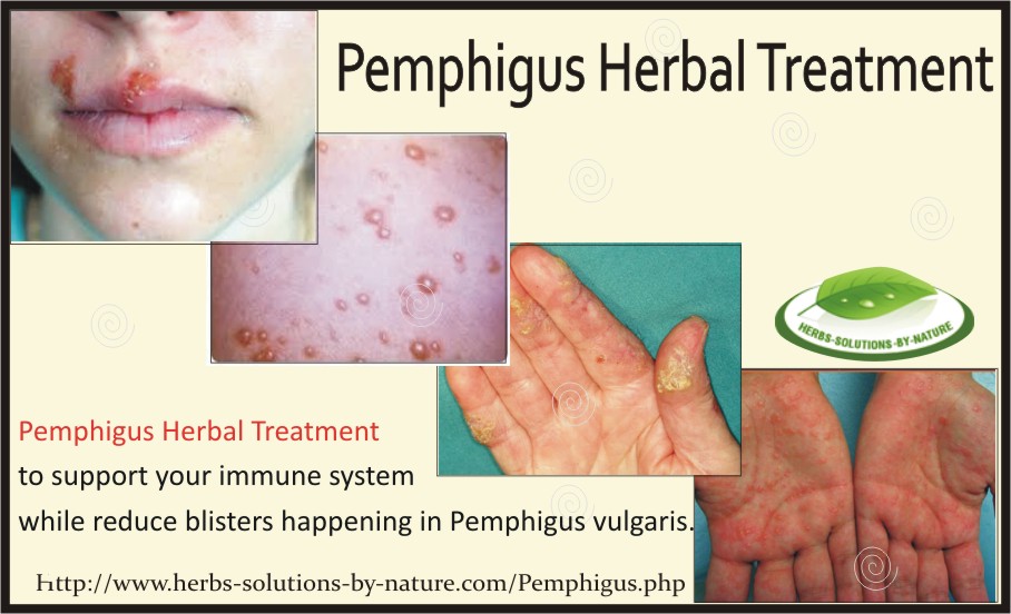 Pemphigus-Herbal-Treatment