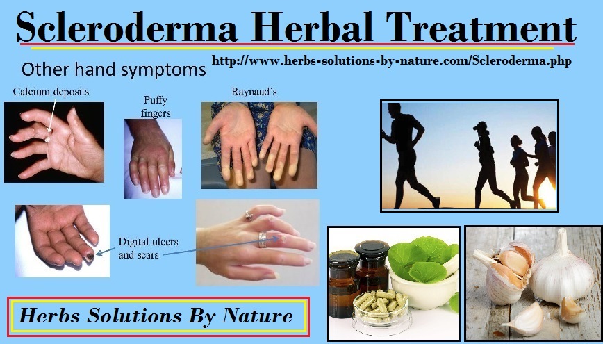 Herbal-Treatment-of-Scleroderma