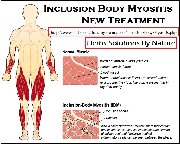 Inclusion Body Myositis New Treatment Herbs Solutions By Nature Blog