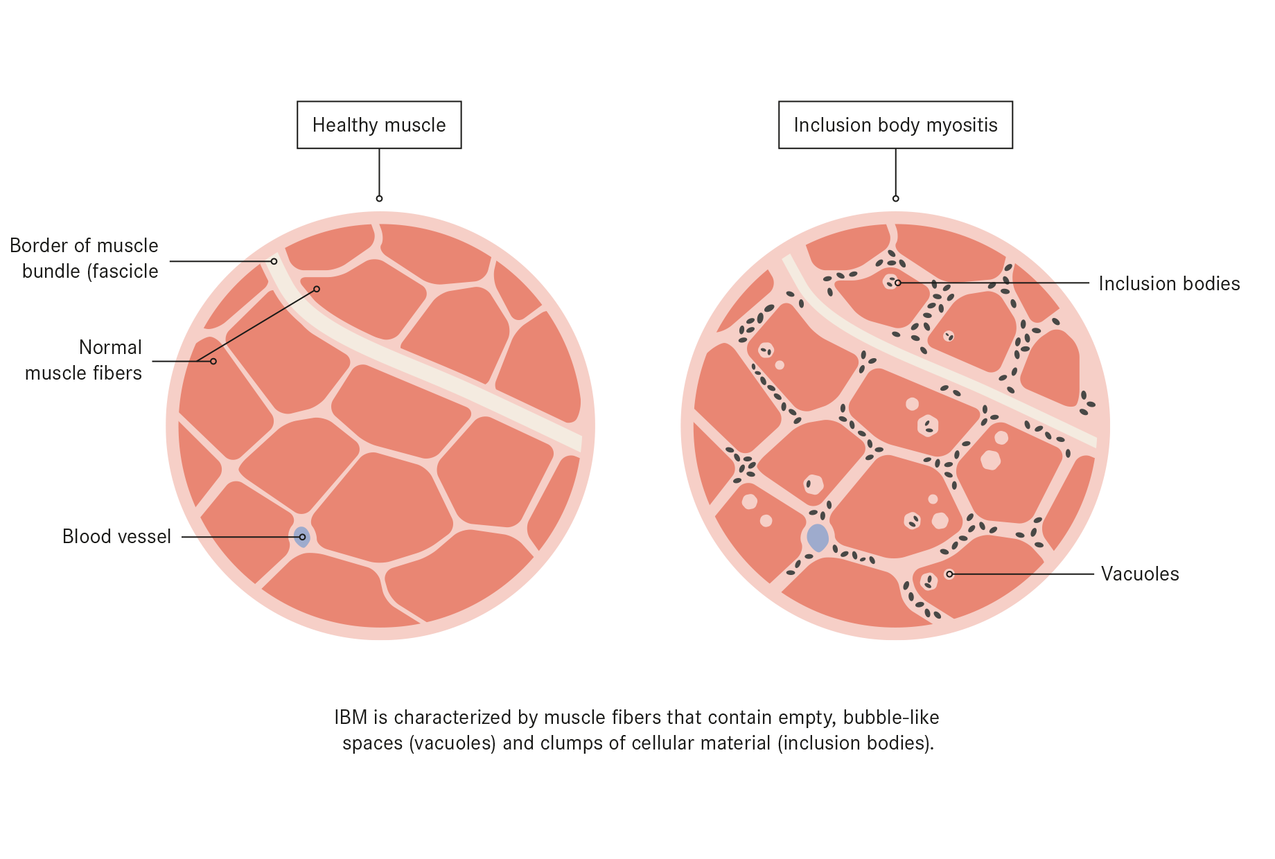 Inclusion Body Myositis