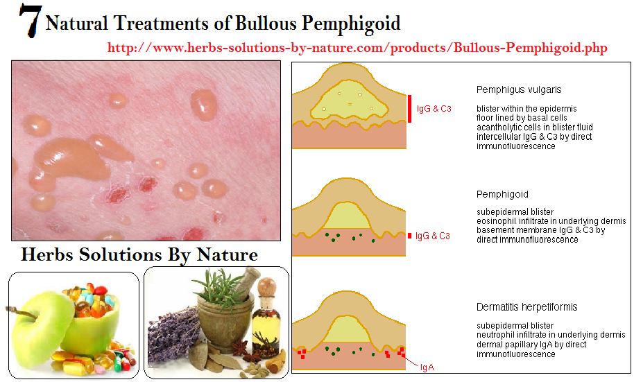 Буллезный герпетиформный дерматит фото 7 Natural Treatments of Bullous Pemphigoid - Herbs Solutions By Nature Blog