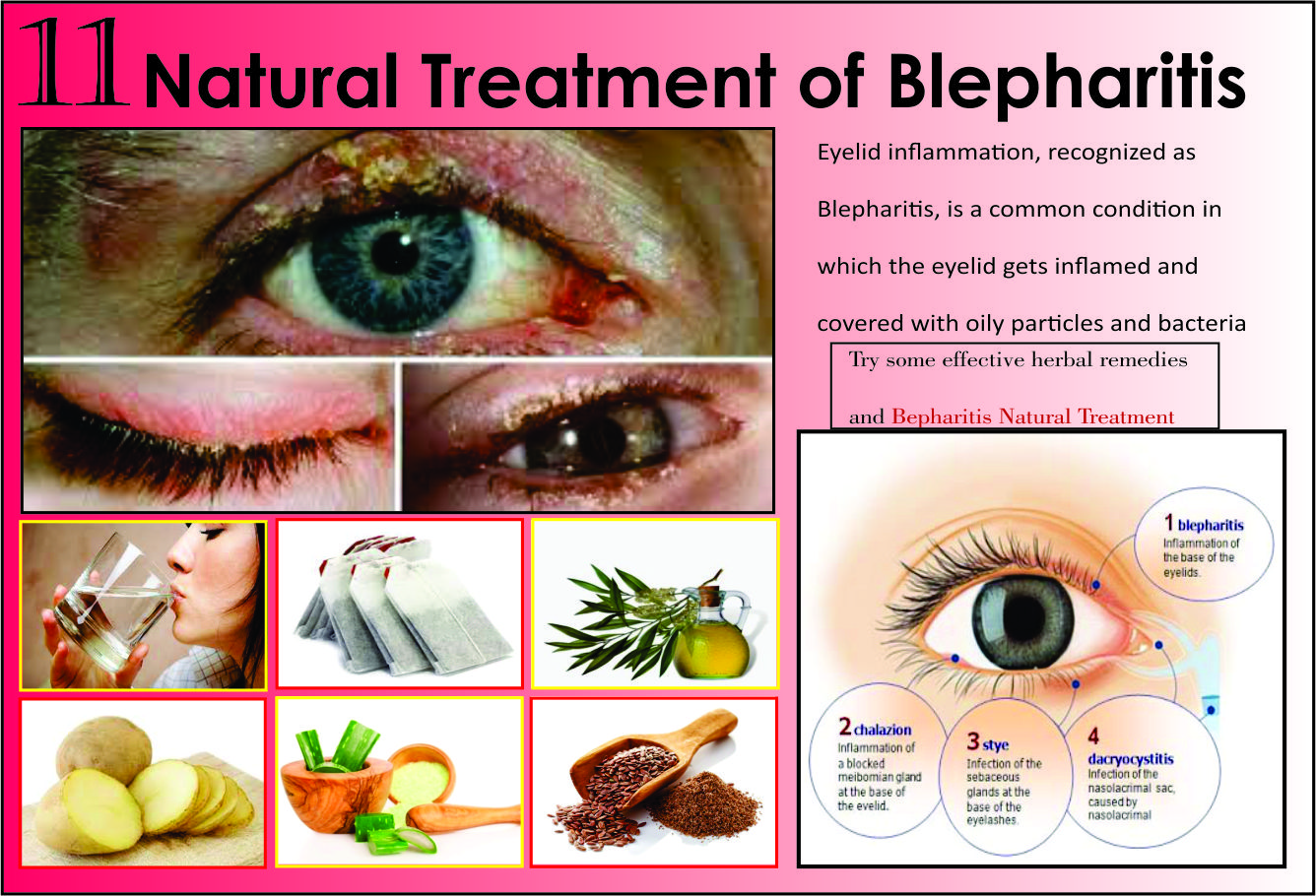 Natural-Treatments-of-Blepharitis