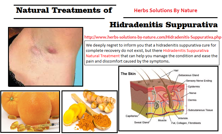 10 Natural Treatments of Hidradenitis Suppurativa - Herbs Solutions By Nature Blog
