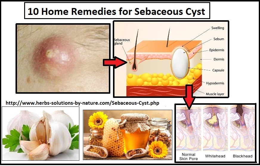 10 Home Remedies For Sebaceous Cyst Natural Treatment Herbs Solutions