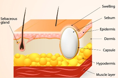 Natural-Treatment-for-Sebaceous-Cyst