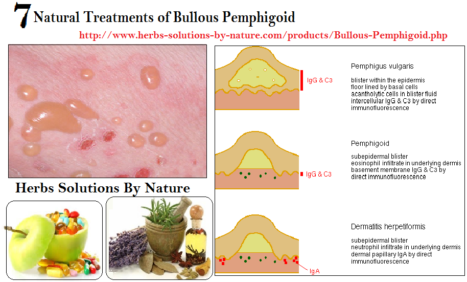 Natural-Treatment-of-Bullous-Pemphigoid