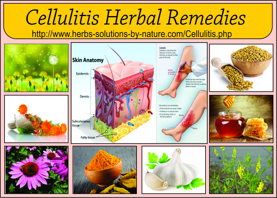 12 Herbal Remedies for Cellulitis Bacterial Skin Infection