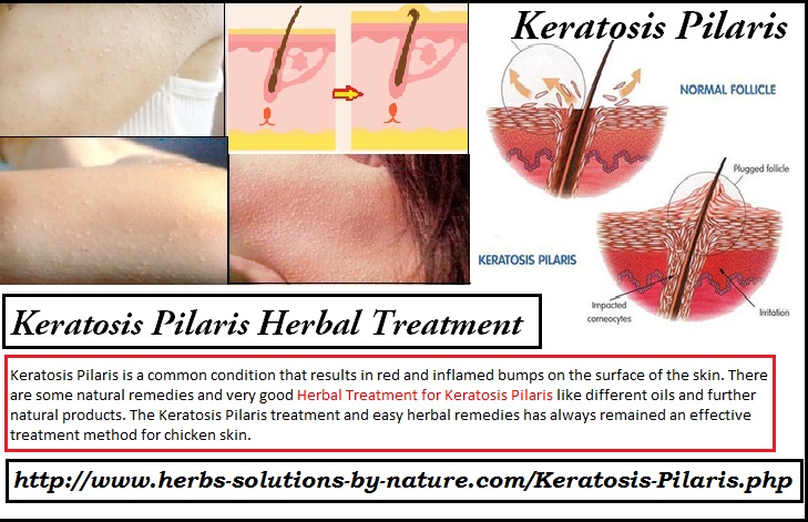 Keratosis-Pilaris-Herbal-Treatment