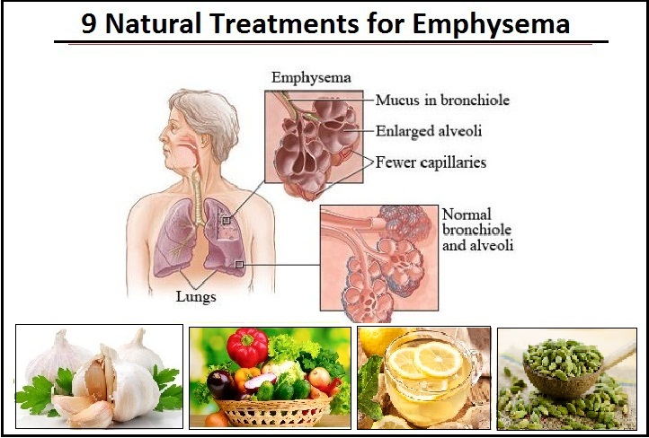 Natural- Treatments-for-Emphysema.