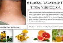 6 Herbal Treatment of Tinea Versicolor