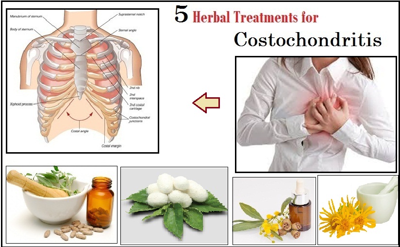 Costochondritis