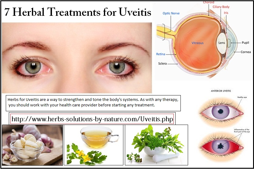 Uveitis