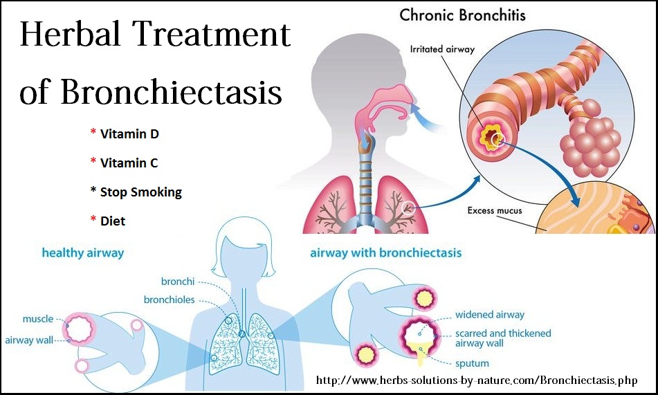 Herbal-Treatment-for-Bronchiectasis