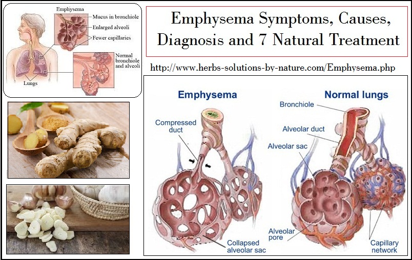 Exclusive Information about Emphysema Symptoms, Causes 