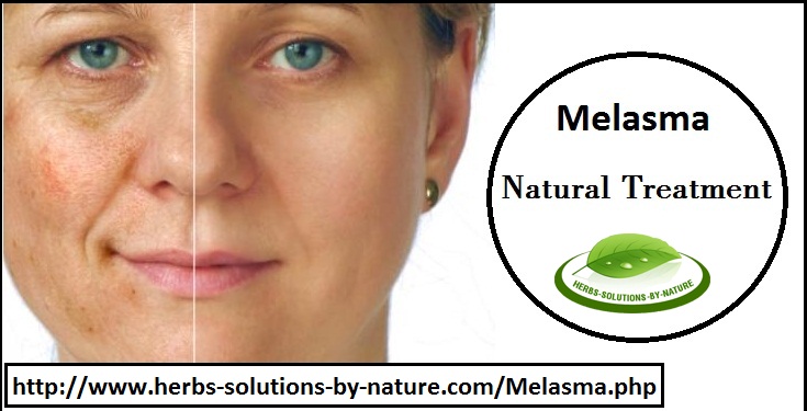 Melasma