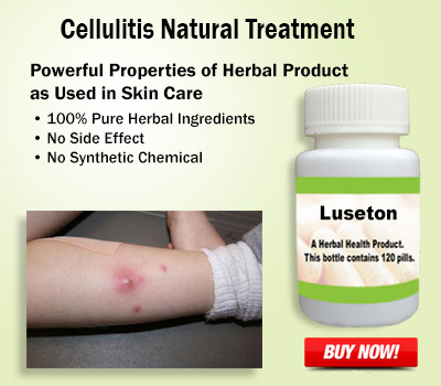 Cellulitis-Natural-Treatment