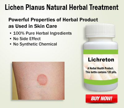 Lichen-Planus-Natural-Herbal-Treatment