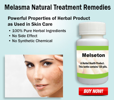Melasma-Natural-Treatment
