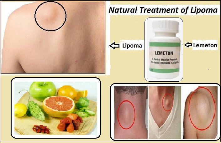 Natural-Treatment-of-Lipoma