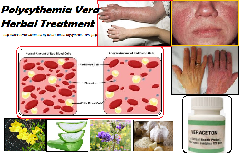 Polycythemia Vera Natural Cure