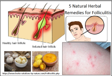 5 Natural Herbal Remedies for Folliculitis