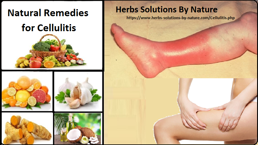 Natural-Remedies-for-Cellulitis