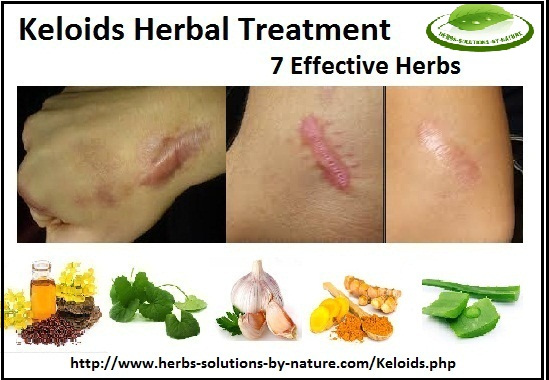 Herbal-Treatment-for-Keloids