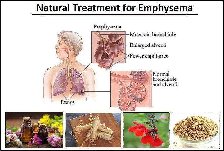 Natural-Treatment-for-Emphysema