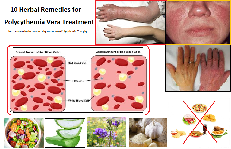 Herbal-Treatment-for-Polycythemia-Vera