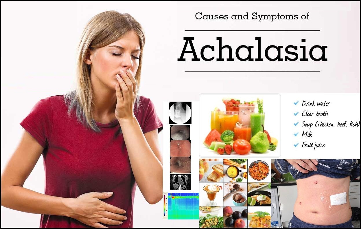 Achalasia-Natural-Treatment