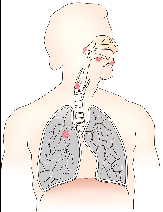 Achalasia-Natural-Treatment