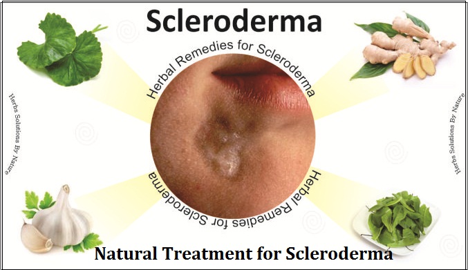Natural-Treatment-for-Scleroderma