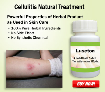 cellulitis home treatment