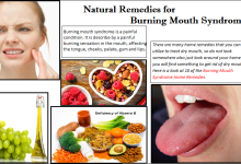 Natural Remedies for Burning Mouth Syndrome and Self-Care Routine